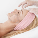 autologiczne nici kolagenowe