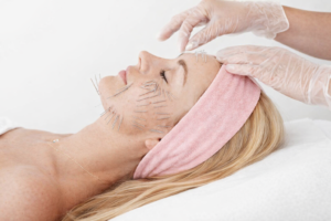 autologiczne nici kolagenowe